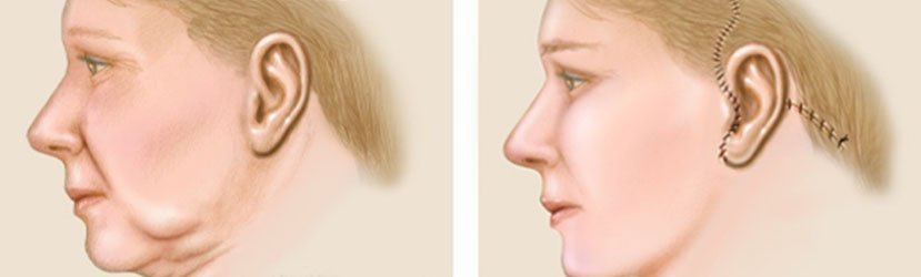 Cirurgia Plástica no Rosto – Lifting Facial (Ritidoplastia)