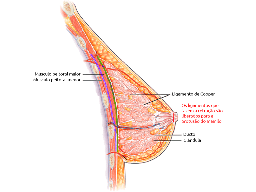 Ilustração da Anatomia dos Ligamentos que Devem ser Liberados Durante o Procedimento