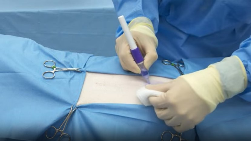 Cirurgia sem ponto já é possível no Brasil