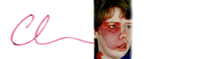 Ilustração de Hemangioma em Face